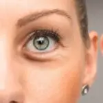 Unterlidstraffung (Tränensäcke OP) Eyelid Aesthetics Hamburg, PD Dr. Simon DUlz