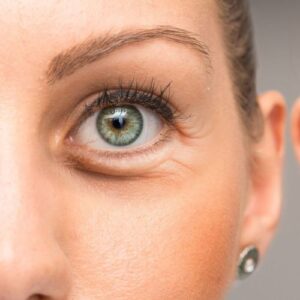 Unterlidstraffung (Tränensäcke OP) Eyelid Aesthetics Hamburg, PD Dr. Simon DUlz